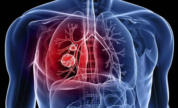 Pernambuco registra aumento em casos de tuberculose