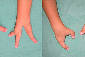 Instituto promove mutirão de cirurgias para corrigir deformidade das mãos em crianças