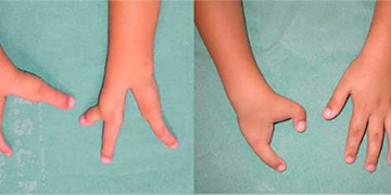 Instituto promove mutirão de cirurgias para corrigir deformidade das mãos em crianças