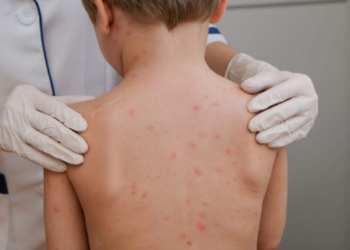 Pernambuco é o terceiro estado do Nordeste com mais casos de meningite em 2026