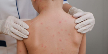 Pernambuco é o terceiro estado do Nordeste com mais casos de meningite em 2026