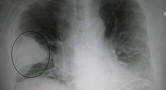 Internações por pneumonia aumentam 66% no IMIP