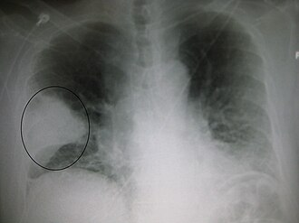 Internações por pneumonia aumentam 66% no IMIP